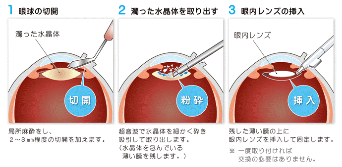 白内障手術の流れ