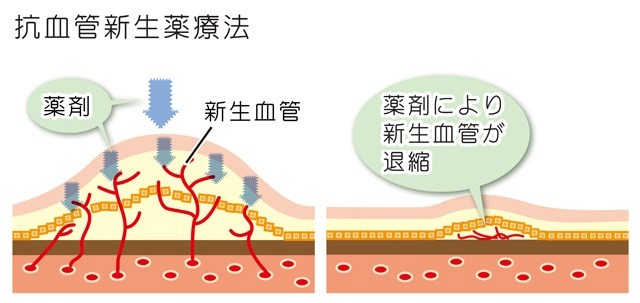 抗VEGF薬療法（硝子体注射）とは