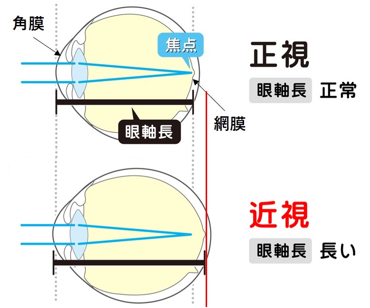 近視抑制外来 東京都中野区にある新江古田いわた眼科