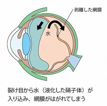 網膜剥離